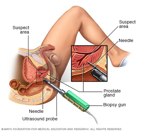 Prostate Cancer: Unveiling the Mysteries