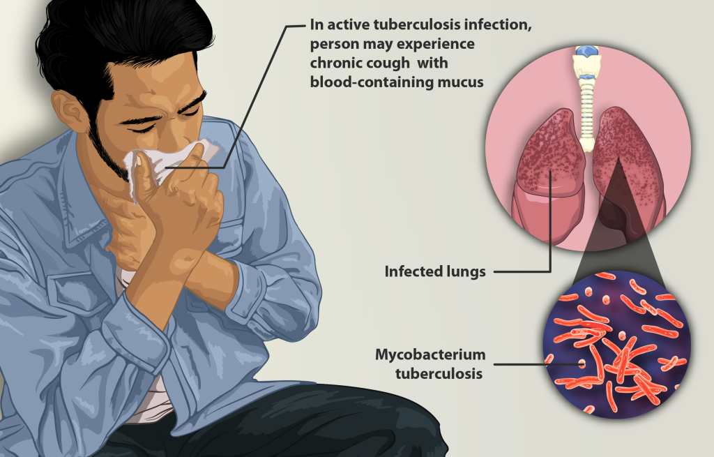 Understanding Tuberculosis: Causes, Symptoms, and Cure