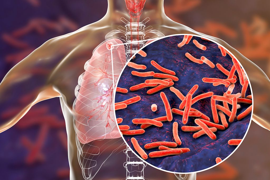 Understanding Tuberculosis: Causes, Symptoms, and Cure